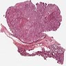 Mucoepidermoid carcinoma of the lung, from Juan Rosai’s Collection of Surgical Pathology Seminars