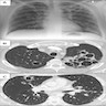 Bilateral well defined cystic spaces in lung