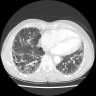 Usual interstitial pneumonia (UIP) pattern