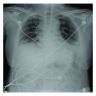 Chest radiograph