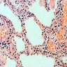 Interstitial inflammation (no inclusions identifiable)