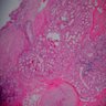 Mucosal glandular hyperplasia