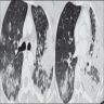 CT of acute HP due to isocyanate