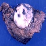 Solid nodule