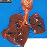 Severe pulmonary hypoplasia