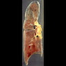 Thromboemboli in pulmonary artery