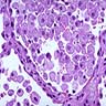 Foamy macrophages in alveolar spaces