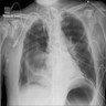 Hyperacute lung transplant rejection