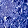 Modified acid fast stain shows weakly acid fast branching, filamentous bacilli