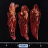 75 year old woman with 1 cm lung lesion