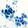 Large malignant cells