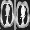 Enhanced and nonenhanced CT scan