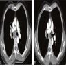 CT before / after targeted therapy