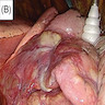 Intraoperative view of white mass with indistinct margins