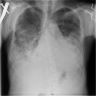 Lower lung heterogeneous opacities
