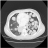 Multiple lung metastases