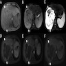 Liver mass on MRI