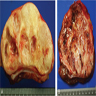Small bowel and liver tumor