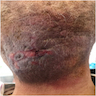 Angiomatous subcutaneous plaque on scalp
