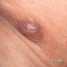 Erythematous nodule on skin