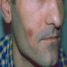 Erythematous nodule on right cheek