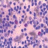 Eosinophils in a reactive background
