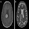 Brain MRI with contrast enhancing lesion