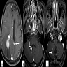 Infiltrates in the cerebral ventricle (MRI)