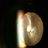 Sheets of white cells (slit lamp)