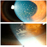 Keratotic precipitates (slit lamp)