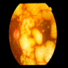 Nodular lymphoma masses (fundus)