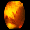 Subretinal lymphoma infiltration (fundus)
