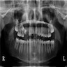 Radiolucency, engulfing tooth, extending beyond crown
