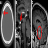 Sagittal T1 weighted contrast-enhanced brain MRI