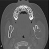 MRI with contrast