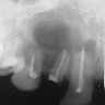 Diffuse periapical radiolucency