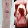 Unilateral maxillary swelling