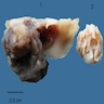 Solid / cystic with calcifications