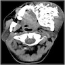 Giant mixed lesion