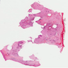 Polyhedral cells with amyloid