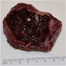 Fleshy, reddish brown, hemorrhagic appearance