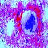 Giant cell with occasional spindle cells and hemorrhagic background