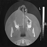 Expansion and thinning of the bony sinus wall