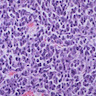 Myeloma plasma cells