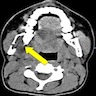 CT scan of mandible