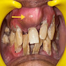 Bony mass in maxilla