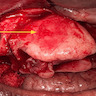 Intraoperative exposure of COF showing clear distinction between the lesion and healthy bone