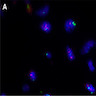 MDM2 amplification by FISH