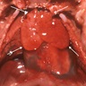Normal thymus, 29 weeks gestation