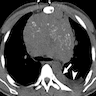CT scan of chest with anterior mediastinal mass 